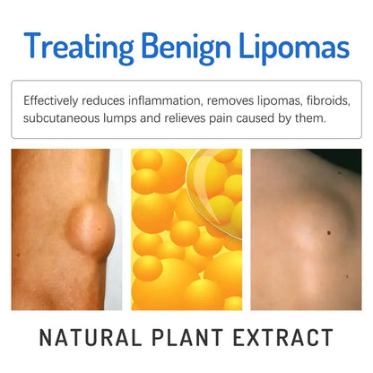 (LAST DAY SALE - 80% OFF🔥)Relieve subcutaneous lumps caused by lipoma-fat cream