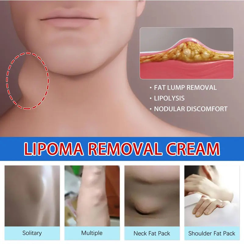 (LAST DAY SALE - 80% OFF🔥)Relieve subcutaneous lumps caused by lipoma-fat cream