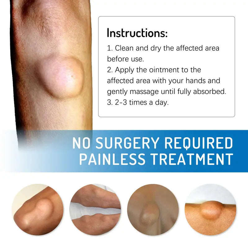 (LAST DAY SALE - 80% OFF🔥)Relieve subcutaneous lumps caused by lipoma-fat cream