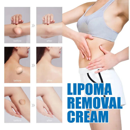 (LAST DAY SALE - 80% OFF🔥)Relieve subcutaneous lumps caused by lipoma-fat cream